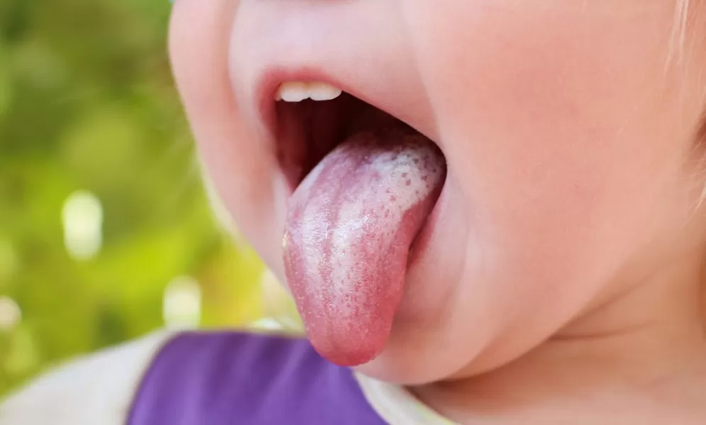 Soor © Victoria М / AdobeStock.com
