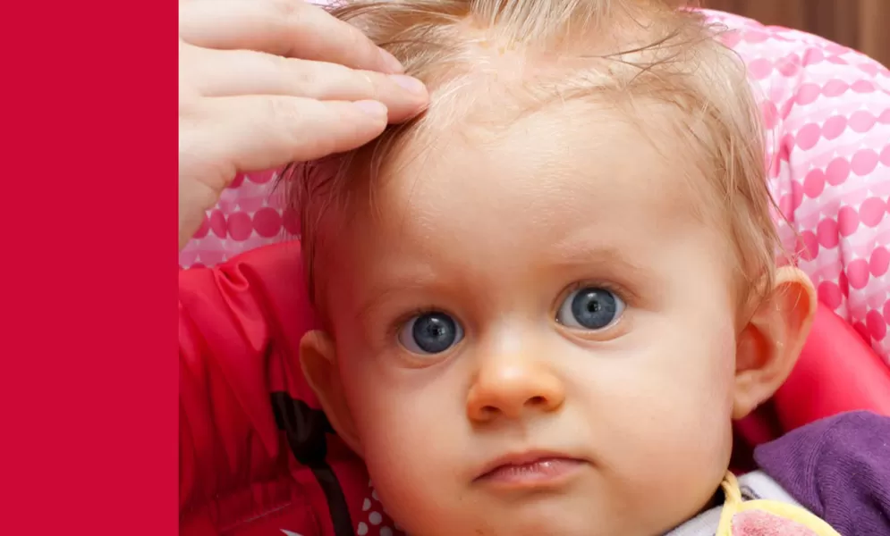 Milchschorf beim Baby © Köpenicker - AdobeStock.com